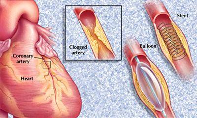 Treating Cardiac Disease With Catheter-Based Tissue Heating